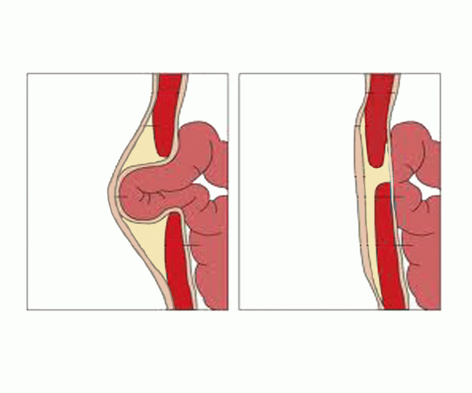 Umbilical hernia growth